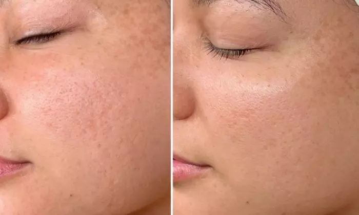 Glow Radiantly w/ One or Three Sessions: Polynucleotide Under Eye or Full-Face (Up to 71% Off) - Image 4