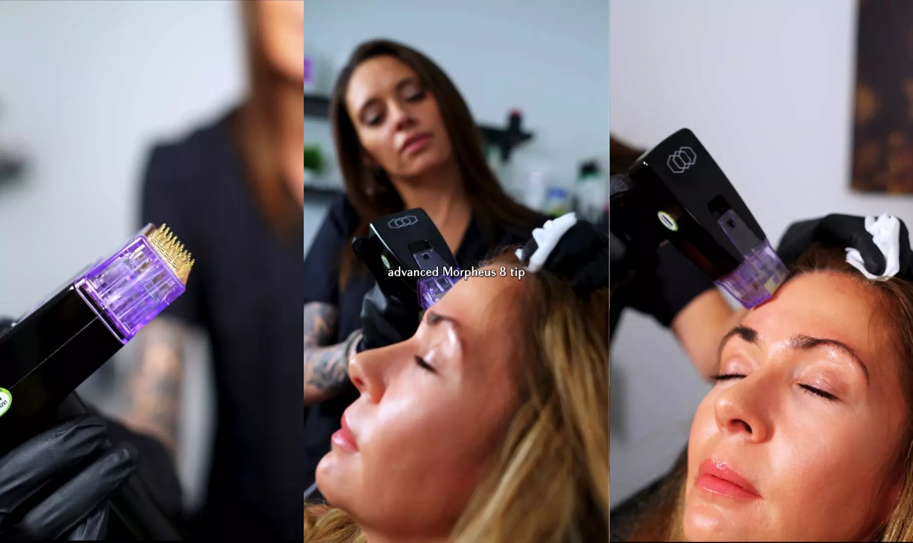 The Real Morpheus8 and PRP packages at 365 Clinical Care