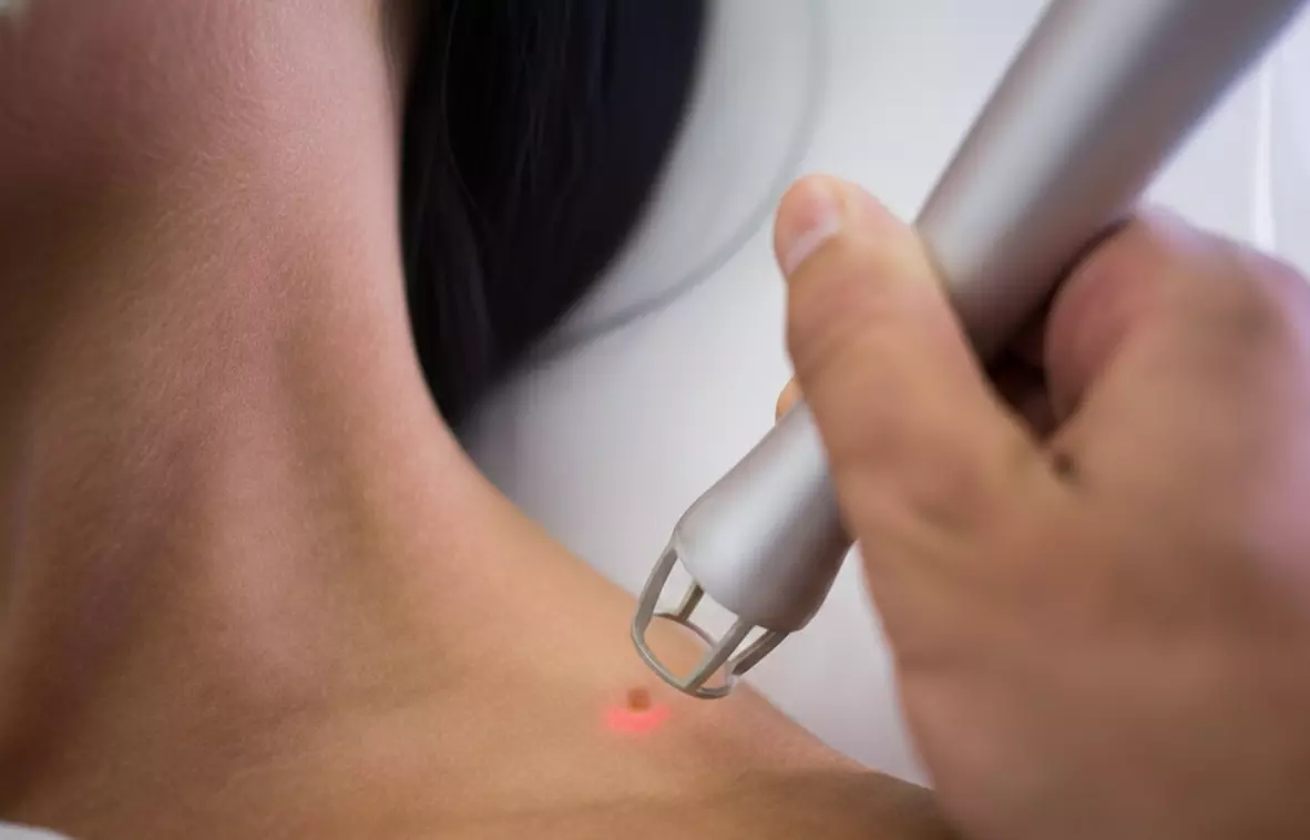 Láser para eliminar lunares, verrugas o puntos rubí: 1, 2 o 3 sesiones