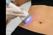 Sculpt & Smooth: Cavitation or Skin Tightening for Abs & Love Handles at Body Canvas Contouring - Second Medium
