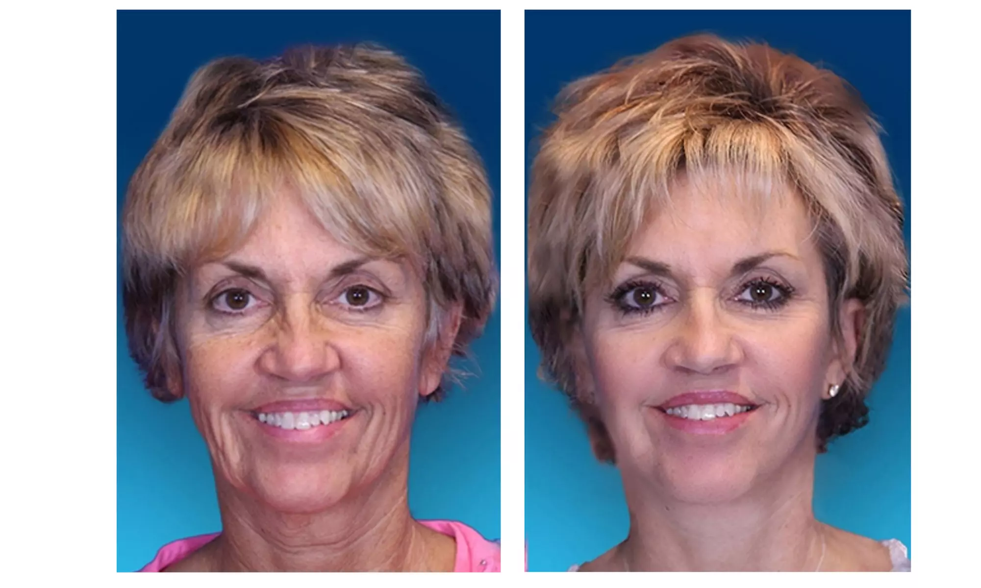 Revitalize Your Skin with Co2 Laser Resurfacing Treatment at Youthful Solutions on 33% Off - Second Medium