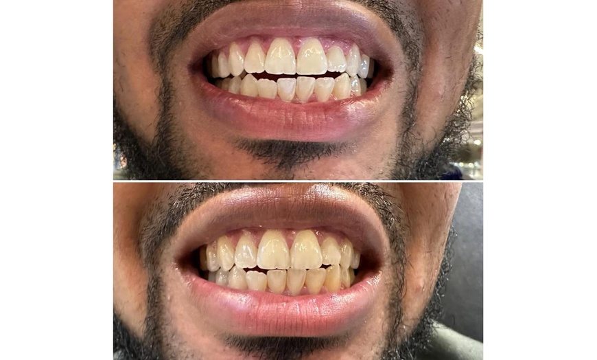 Image 8: Teeth Whitening with Carbamide Peroxide