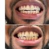 Image 8: Teeth Whitening with Carbamide Peroxide