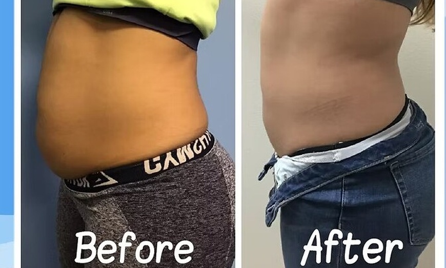 Image 3: One, Two or Three Fat Freezing Treatments Awaits for a Slimmer You