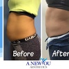 Image 3: One, Two or Three Fat Freezing Treatments Awaits for a Slimmer You