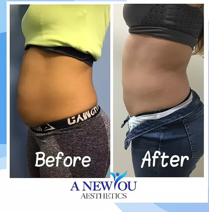 One, Two or Three Fat Freezing Treatments Awaits for a Slimmer You