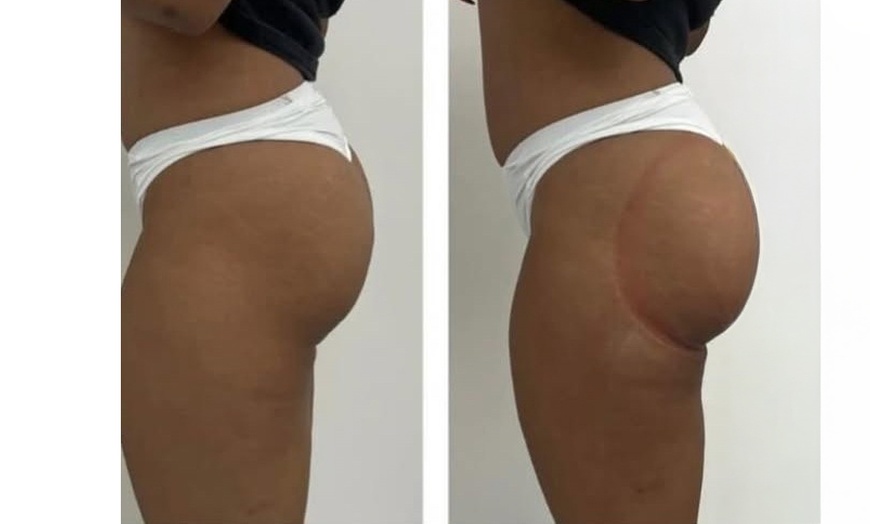 Image 2: Lift and Contour with Vacuum BBL - One, Three, or Six Sessions