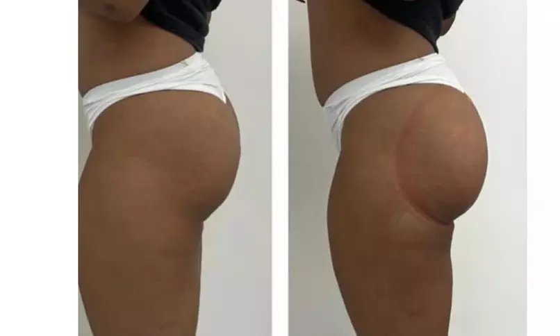 Lift and Contour with Vacuum BBL - One, Three, or Six Sessions