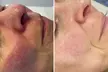 Microneedling-Behandlung  mit hochwertigen Cocktails oder Enzym-Lifting-Paket für 1 Person (50% sparen) - Second Medium