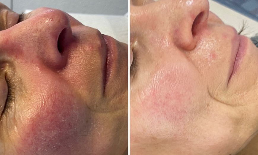 Image 4: Microneedling-Behandlung oder Enzym-Lifting-Paket für 1 Person