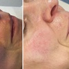 Image 4: Microneedling-Behandlung oder Enzym-Lifting-Paket für 1 Person