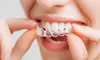 Transform Your Smile with All-Inclusive Clear Aligners with Free Whitening Kit at Smilewave Aligners & Braces