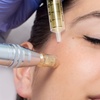 Image 1: 1 o 2 sesiones de Dermapen facial con vitaminas para 1 persona 