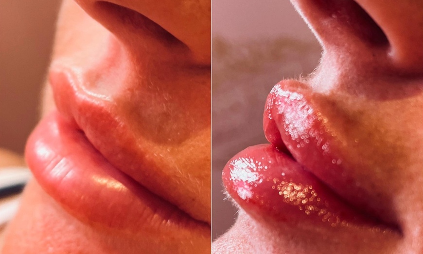 Image 2: Up to 65% Off on Injection - Dermal Filler at Dolls Aesthetics Academy