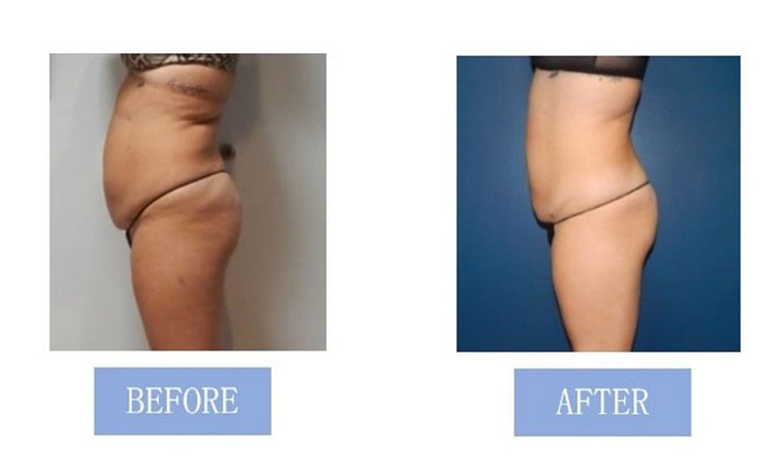 Image 8: Fat Buster or The Works – Body Consultation, Analysis, or More