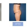 Image 8: Fat Buster or The Works – Body Consultation, Analysis, or More
