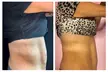 3 or 6 Body Sculpting Sessions: Abdomen, Back, Thighs, Buttocks & More at Artistry Body Studio (Up to 50% Off) - Second Medium