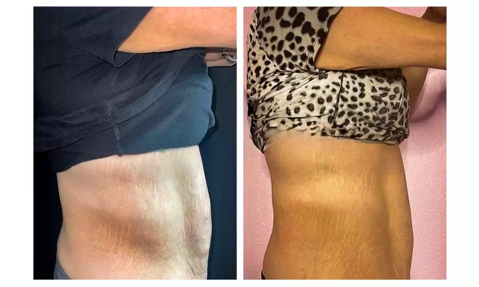 3 or 6 Body Sculpting Sessions: Abdomen, Back, Thighs, Buttocks & More