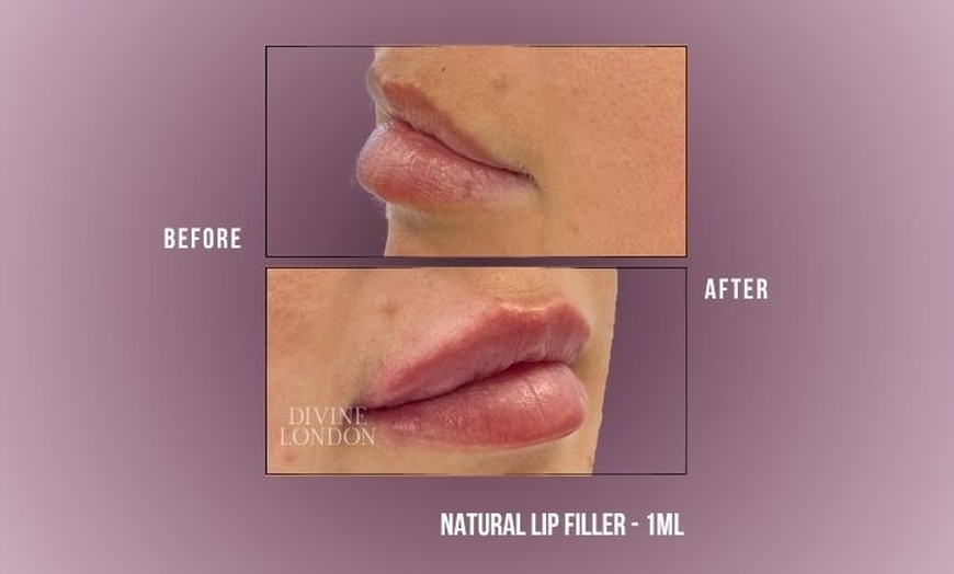 Image 7: Up to 71% Off on Injection - Dermal Filler at Divine Aesthetics Clinic London