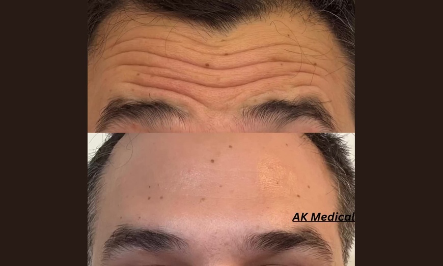 Image 2: Smooth & Plump: Botox and Juvéderm Custom Aesthetic Packages