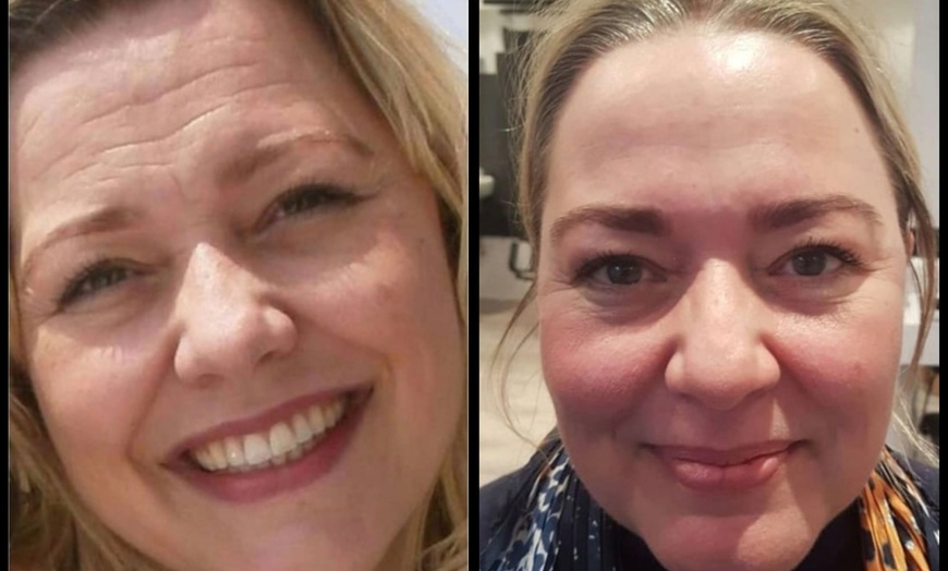 Image 7: Enhance Natural Beauty with Expert Dermal Filler Injections(0.5ml–2ml)