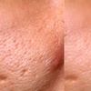 Image 4: CO2 Skin Resurfacing Treatment: Full-Face/Neck and Décolletage/Tummy