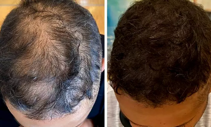 Scalp Micropigmentation Hair Loss, Balding, or Thinning Treatment