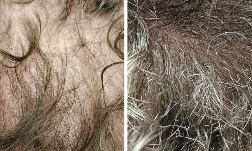 Image 2: PRP & PRF Consultation and Treatment Options for Hair