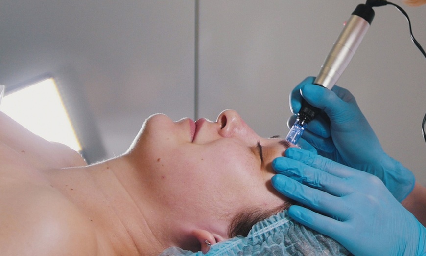 Image 1: 1 o 2 sesiones de exosomas con dermapen en rostro con limpieza facial 