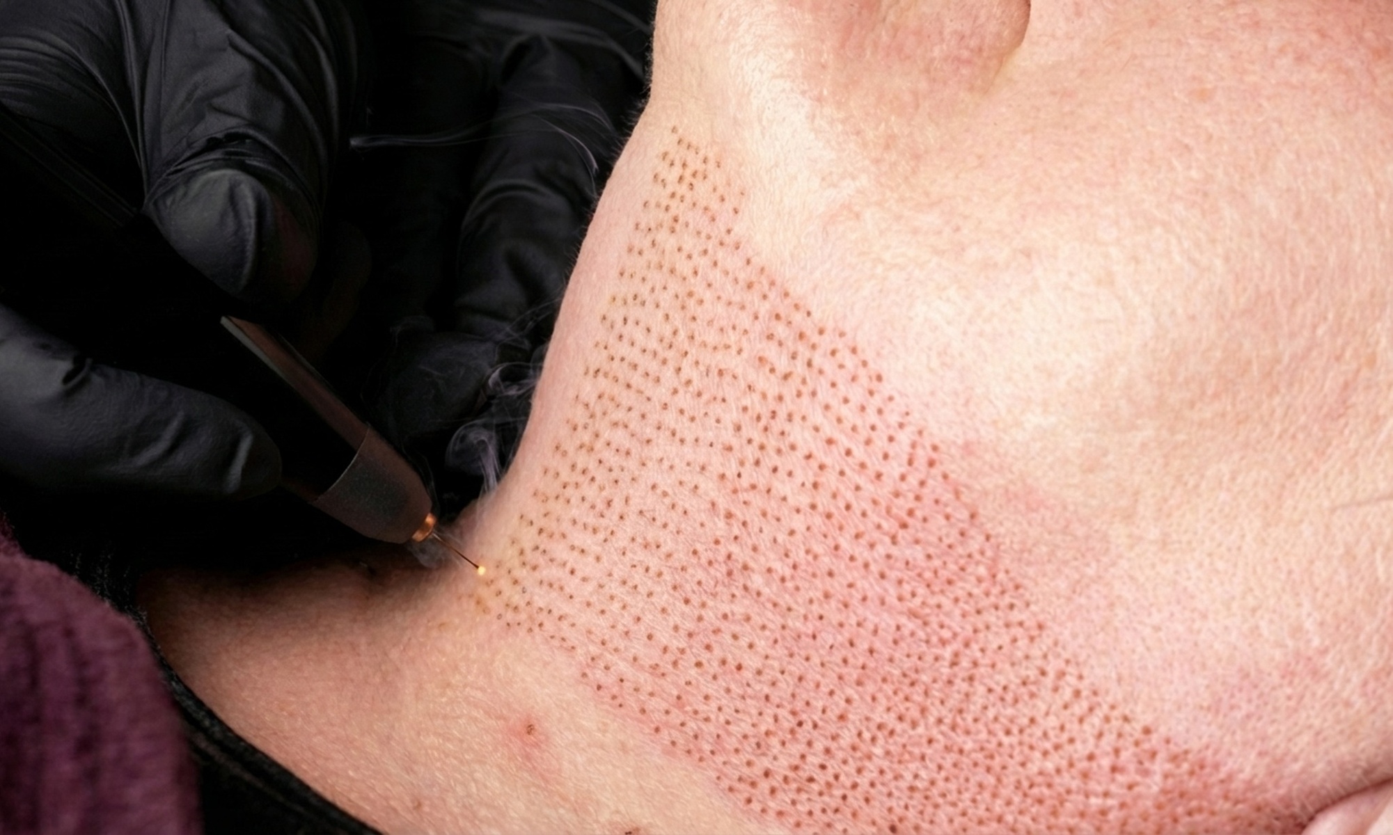 Plasma Fibroblast: Non-Surgical Skin Tightening for Youthful Skin