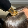 Image 1: Non-Invasive Three Laser Hair Restoration with FoLix Treatments