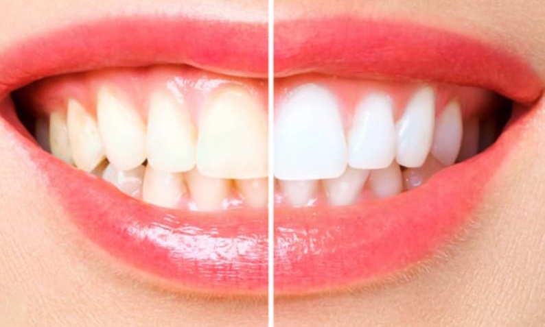 Diamant Zahn-Bleaching inkl. 3 Gelanwendungen für 1 Person