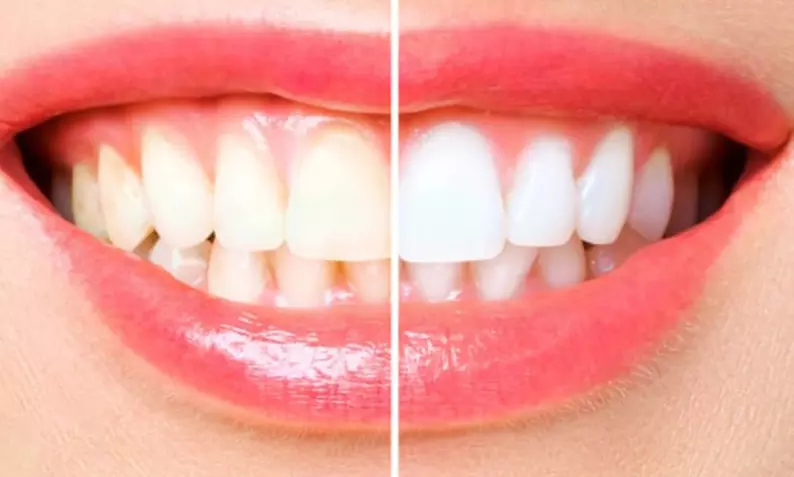 Diamant Zahn-Bleaching inkl. 3 Gelanwendungen für 1 Person