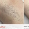 Image 5: Eight Laser Hair Removal Sessions at Lotus Health & Aesthetics Spa
