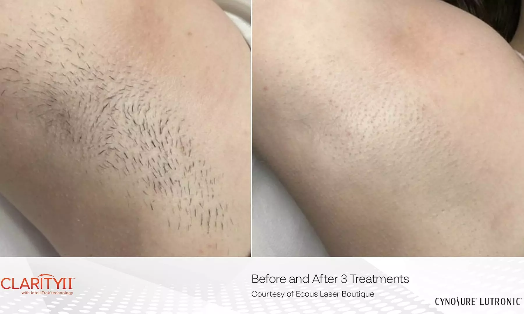 Eight Laser Hair Removal Sessions at Lotus Health & Aesthetics Spa