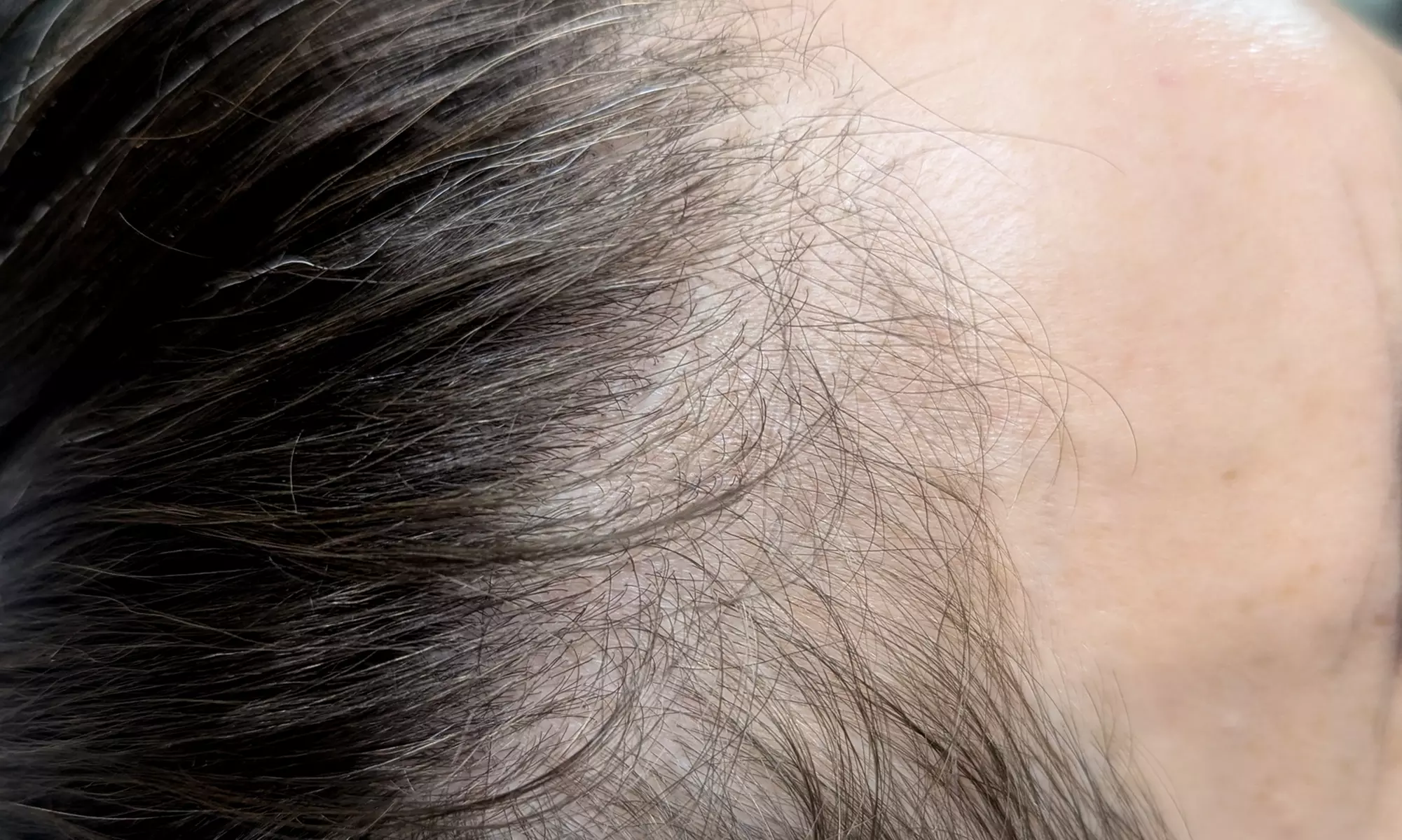 Scalp Micropigmentation Hair Loss, Balding, or Thinning Treatment