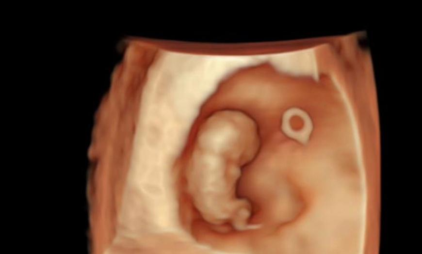 Image 4: Primera ecografía 5D o pack con las 2 primeras ecografías 