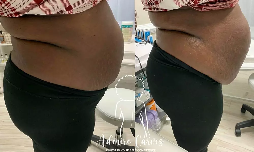 Birthday Body Sculpting Packages for Waist, Tummy & Thigh Body