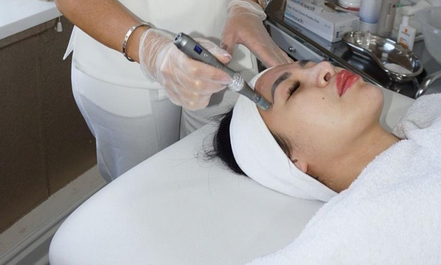 Image 1: Revitalize with One or Two Sessions Deluxe Microneedling - Face & Neck