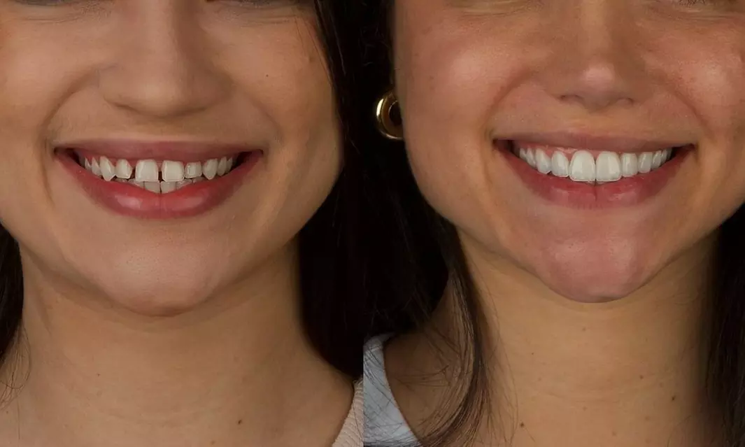 Colocación de hasta 4 carillas dentales de composite o cerámica