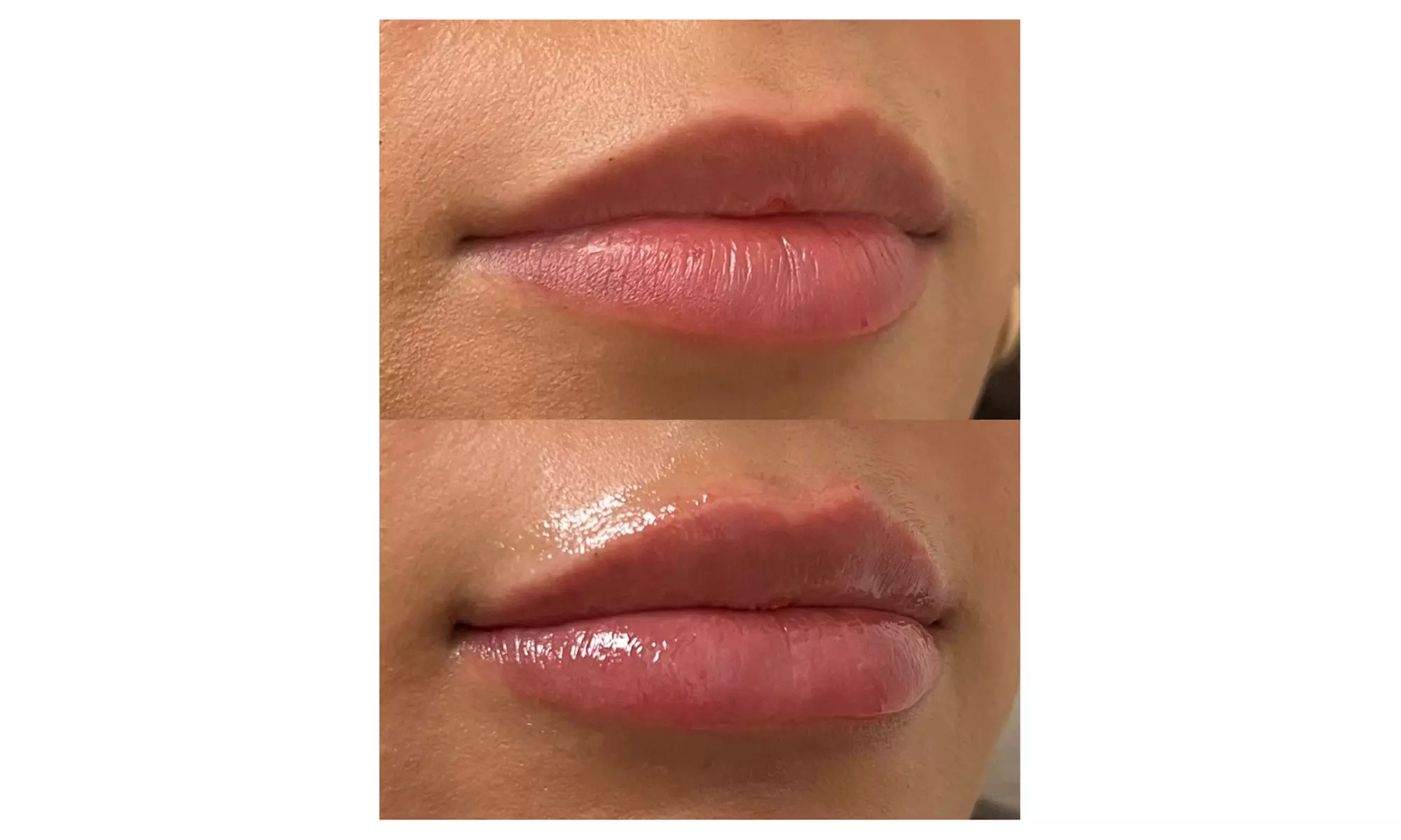 Up to 49% Off on Injection - Dermal Filler at Spa Bella Medispa