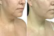 Precision TX Lower Face and Neck Tightening Treatment at Rafael Diaz-Yoserev, MD., FACS (Up to 1% Off) - Image 3