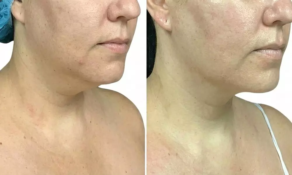 Precision TX Lower Face and Neck Tightening Treatment