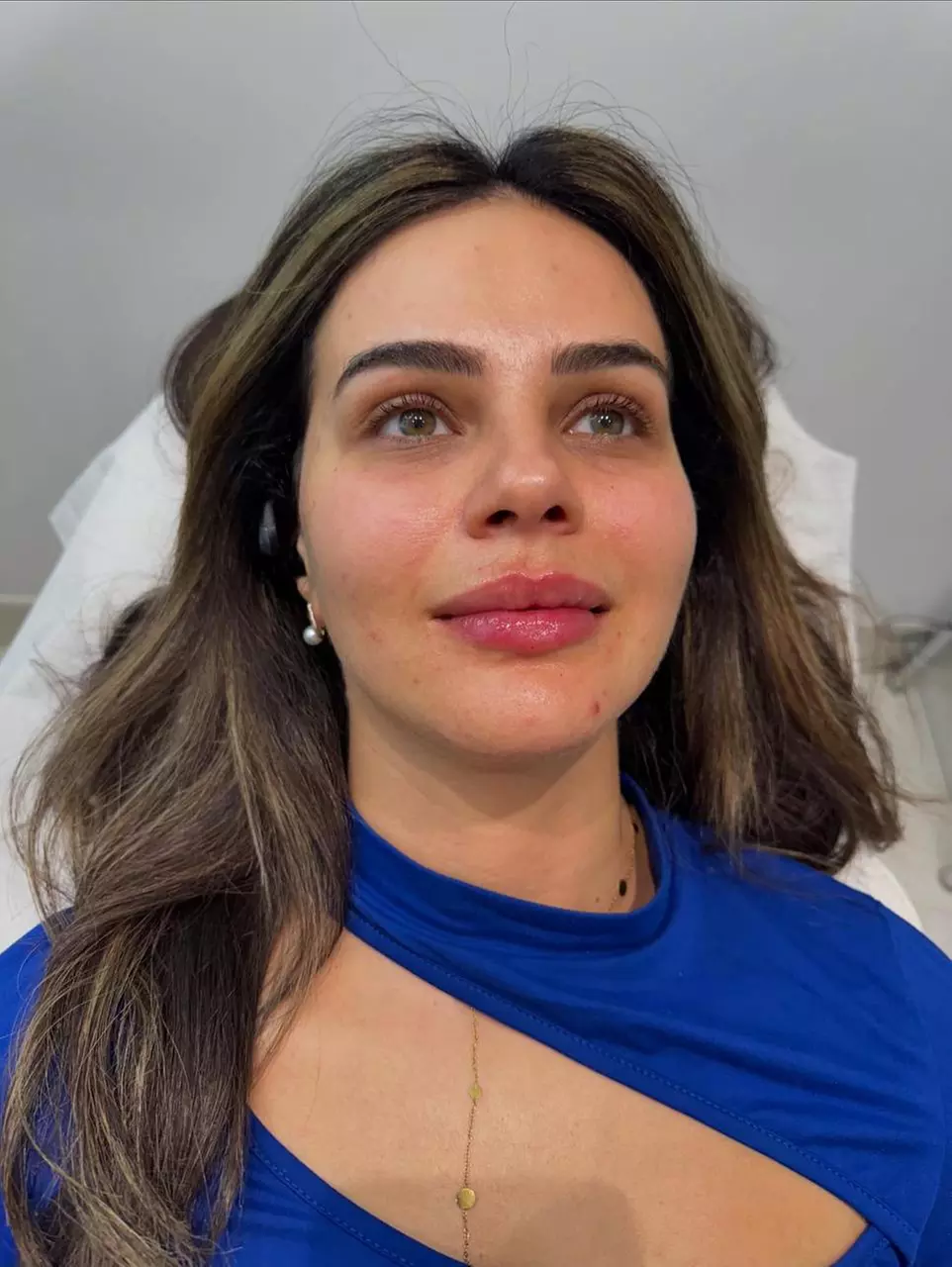 Targeted Dermal Filler Treatments for Lips, Eyes & Facial Lines