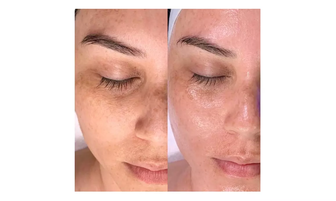One or Two Hydrafacials with Peel-Off Mask, LED Therapy & More