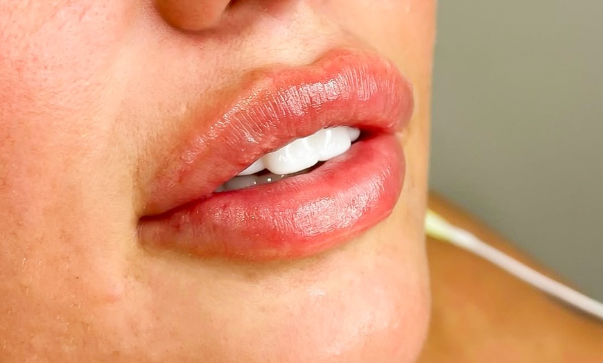 Image 4: Enhance your Beauty with Dermal Filler with Consultation