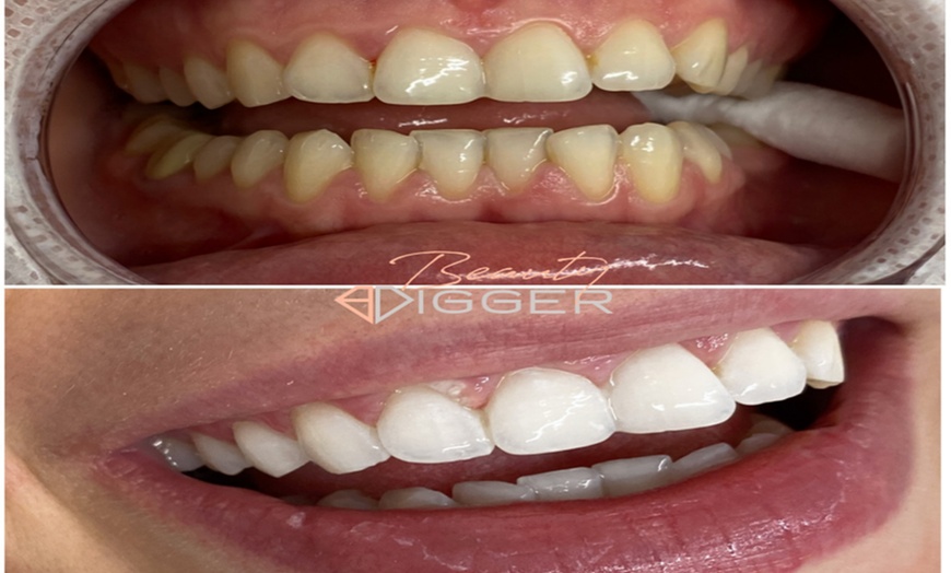 Image 2: Experience Dazzling Results with In-Office Zoom Teeth Whitening!