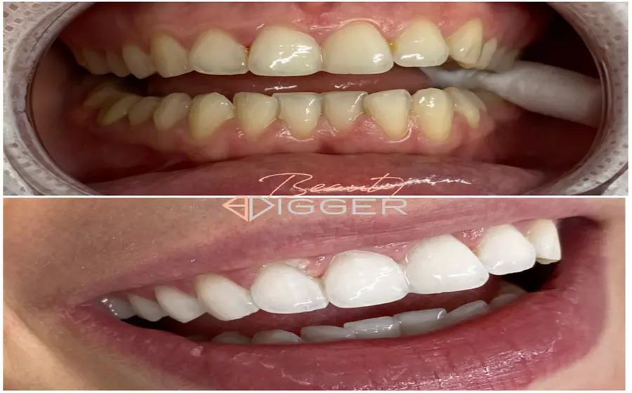 Experience Dazzling Results with In-Office Zoom Teeth Whitening!