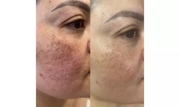 Ultra Pico Laser Intimate Brightening for Brazilian or Inner Thighs