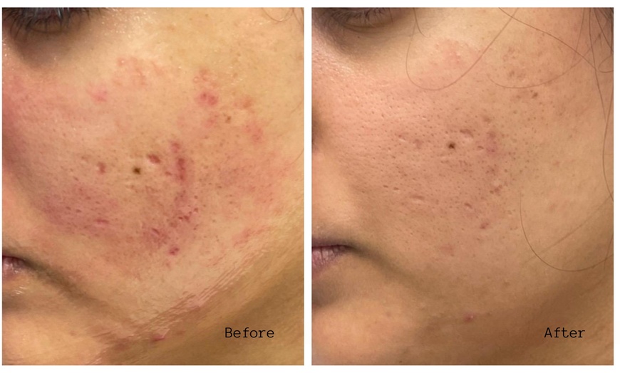 Image 6: One or Three Sessions of Microneedling with/without LED Light Therapy
